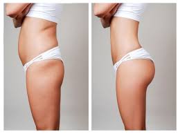 Liposuction Body Contouring Plastic Surgeon Lafayette La