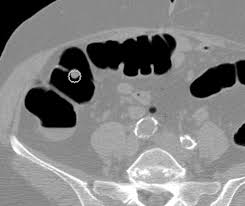 No study in the medical literature demonstrates a similar effect for ct colonography because polyp removal can only be accomplished with traditional colonoscopy. Ct Colonography Colorectal Cancer Screening Cedars Sinai