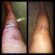 Acl Surgery Acl Surgery Triangle Tattoo Tattoos