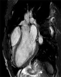 Image result for Cardiac MRI