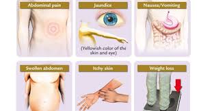 Symptoms Of Liver Cancer And Prevention Measures To Take