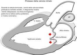 Buongiorni, sono un ragazzo di 30 anni, alla nascita mi è stato diagnosticato un piccolo soffio al cuore a cui, i medici non hanno dato peso. Sindrome Da Prolasso Valvolare Mitralico Wikipedia