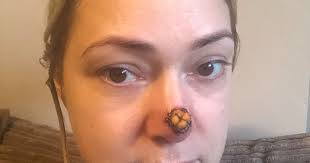 A pearly brown or black lump if you have darker skin. Mum Was Told Spot On The End Of Her Nose Was Cancer Which Was Eating Her Flesh Away Lincolnshire Live