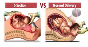 C Section Vs Natural Birth Tummy Talk Mom