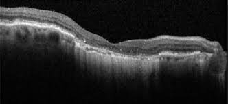 Maybe you would like to learn more about one of these? Age Related Macular Degeneration Medical Clinics