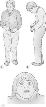 Maybe you would like to learn more about one of these? Parkinson S Disease Basicmedical Key