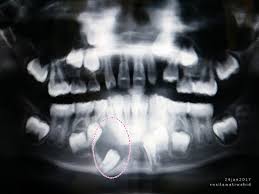 Hospital putrajaya bahagian x ray. Bahaya Bengkak Gusi