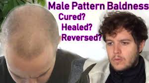 If your hair is thinning, talk with your doctor and get some simple blood tests that may reveal the underlying cause of your hair loss. Can You Reverse Male Pattern Baldness Reversing Male Pattern Baldness Naturally Youtube
