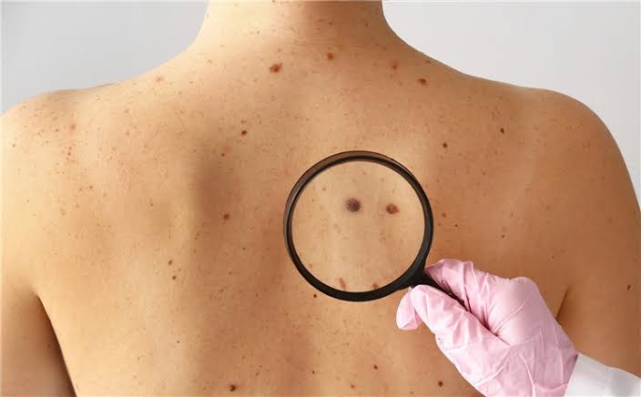 Da Bị Đốm Đen Là Bệnh Gì? Nguyên Nhân, Điều Trị & Phòng Ngừa Hiệu Quả