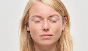 Image result for xanthelasma of eyelid