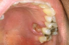 Image result for Mouth ulcers symptoms roof of the mouth
