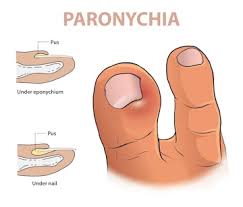 Image result for paronychium