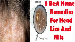 How To Remove Lice Eggs From Hair Home Remedies