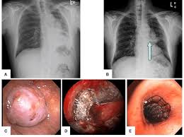 Image result for Lung Cancer