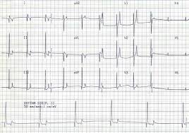 Image result for Hyperkalemia
