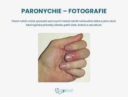 Image result for Akutní zánět nehtového lůžka
