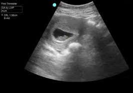 Image result for First Trimester Ultrasound