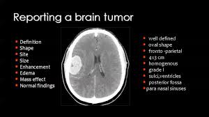 Brain Tumours Imaging Radiology Imaging Mri Brain Brain Tumor
