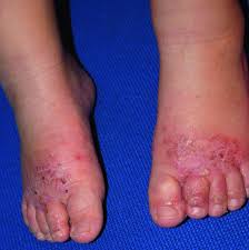 Image result for dermatitis contacta children
