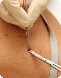 The strongest risk factor for developing skin cancer is ultraviolet (uv) ray exposure, typically from the sun. Skin Cancer Canada Ca