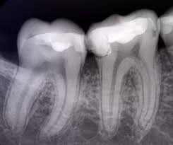 Esthétique dentaire, dentiste, endodontiste, implantologiste , chirurgie buccale, orthodontiste, pédodontiste, parodontologiste à marrakech. Iso X Cabinet De Radiologie Si Imagistica Medicala
