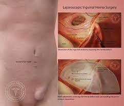 Inguinal Hernia Repair Los Angeles Pasadena Orange County Ca