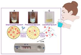 Image result for Sputum