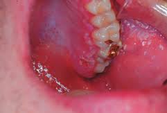 Gingivostomatitis is a combination of gingivitis and stomatitis, or an inflammation of the oral mucosa and gingiva. Https Www Cda Adc Ca Jcda Vol 68 Issue 4 247 Pdf