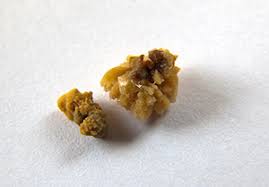 E' consigliabile accompagnare alimenti ad alto contenuto di ossalato con alimenti ad alto contenuto di calcio, come ad esempio i latticini e i molluschi. Prevenzione Dei Calcoli Di Ossalato Di Calcio Quale Dieta Dr Francesco Varvello Urologo E Andrologo