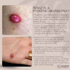 Image result for Pyogenic Granuloma