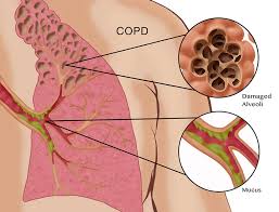 Image result for Chronic obstructive pulmonary disease