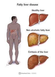 Medical infographic on fatty liver disease: healthy liver, fatty liver, and cirrhosis progression
