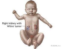 1 dominick ferraro died from a heart attack in 1943. Wilms Tumor Physiopedia