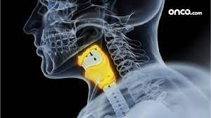 What does throat cancer feel like? Stage 1 Throat Cancer Early Localized Throat Cancer Onco Com