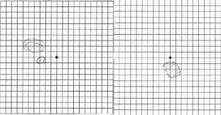 Amsler Grid Eye Test Of Right On The Right And Left On