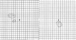 amsler grid eye test of right on the right and left on