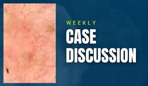 Image result for Macule