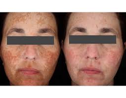 Image result for Melasma calycinum
