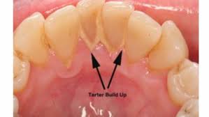 $150 to $650 for a surgical extraction utilizing anesthesia. Does Everyone Need A 6 Month Dental Clean Up As Suggested By Dentists What Are Some Routine Things You Can Do To Improve Your Dental Health And Reduce Your Visits To Dentists