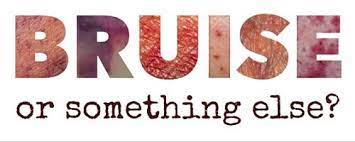 Excessive bruising and bleeding—bruises often appearing from internal bleeding—are the most common purpura symptoms of itp. Is It Really A Bruise Get The Bigger Picture On Skin Lesions Wcei