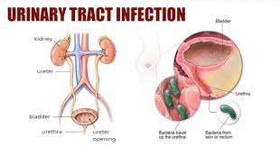 Anyone Who Suffers From Urinary Tract Infection Knows And Dreads The Painful Burning Sensa Urinary Tract Infection Remedies For Kidney Infection Urinary Tract