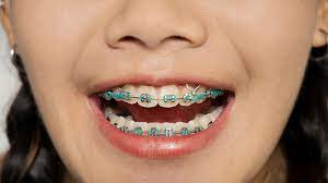 Anyway, i follow the brushing techniques and i think i'm doing okay. Braces With Rubber Bands Purpose And How Long They Stay On