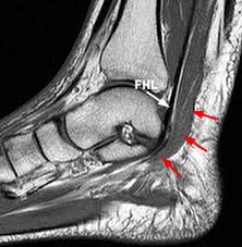 Lateral and medial processes of calcaneal tuberosity, and band of connective tissue connecti. Accessory Muscles Of The Ankle Radsource