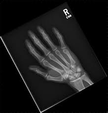Oral health doesn't have to be costly. Fractured My Hand No Insurance Can T Afford A Follow Up Is It Necessary X Rays Inside X Post From R Askdocs Orthopaedics