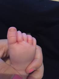 A long blonde hair wrapped around his toe. Hair Wrapped On Baby 39 S Toe November 2015 Babies Forums What To Expect
