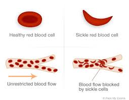 Sickle Cell Disease Foundation Of California Nonprofit Ontario Ca Usa Missionbox