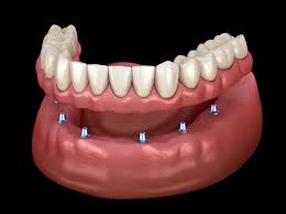 Image result for dentures