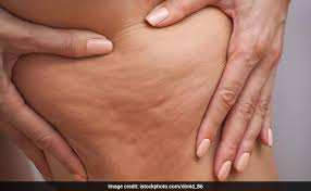 Velashape cellulite treatment is a fantastic way to enhance your skin and improve your overall appearance. 9 Effective Ways To Get Rid Of Cellulite Ndtv Food