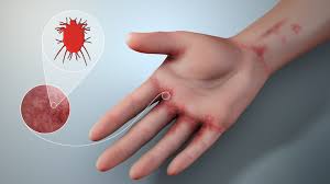 Image result for what does scabie look like