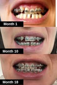 ¹ smilepay™ is $89/month for 24 months ($2,386 total) with a $250 deposit. How To Get Braces Uk Arxiusarquitectura